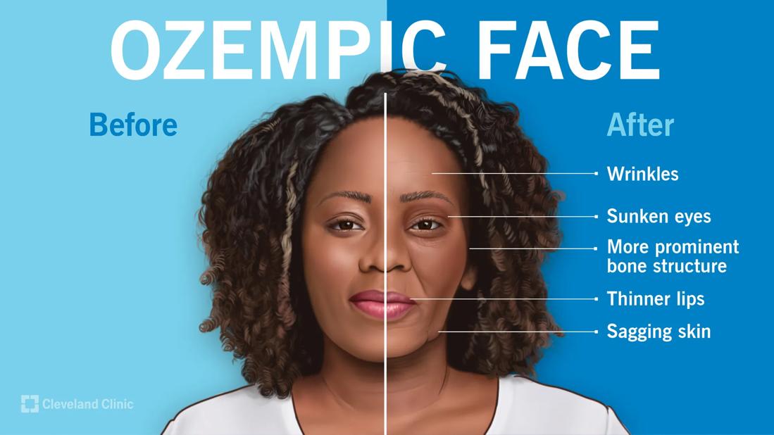 What Is 'Ozempic Face' and How To Prevent It
